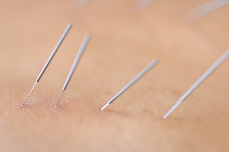 Can Acupuncture Help Anxiety When Therapy Alone Isn’t Enough