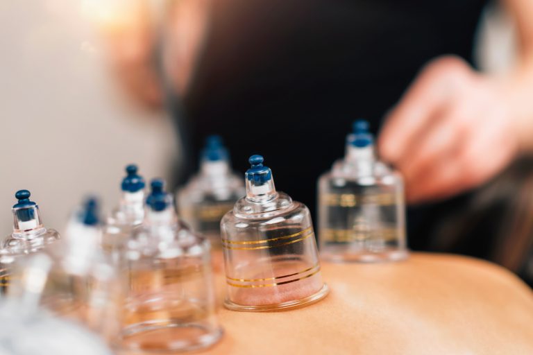 Unlocking the Healing Power of Cupping Therapy at Weng’s Acupuncture & Herbs Clinic