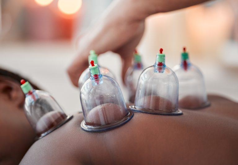 What Cupping Therapy Marks Really Mean for Your Body
