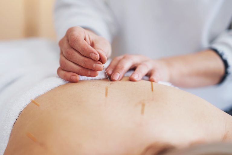 How Acupuncture Can Help Regulate Hormones Naturally
